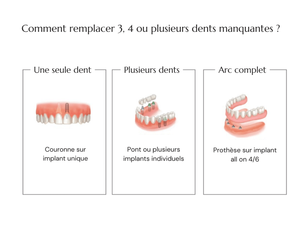 Comment Remplacer Plusieurs Dents Manquantes