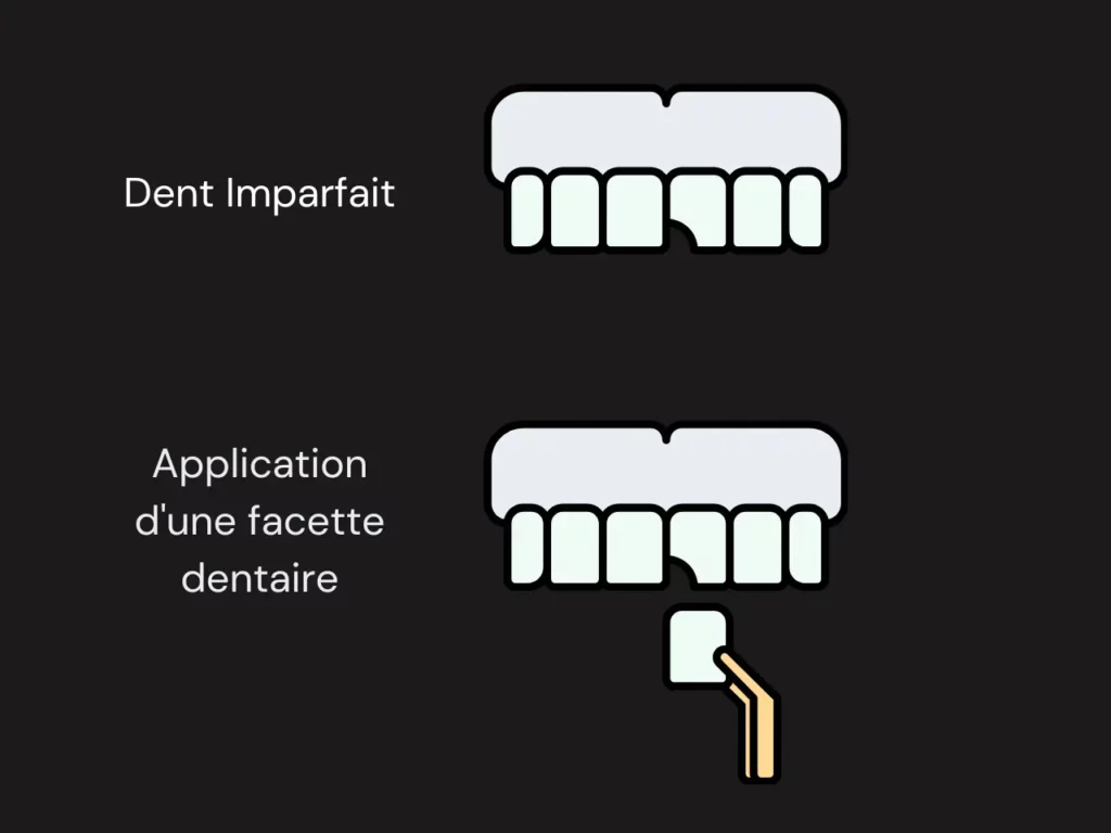 Facettes Dentaires Ce Quoi