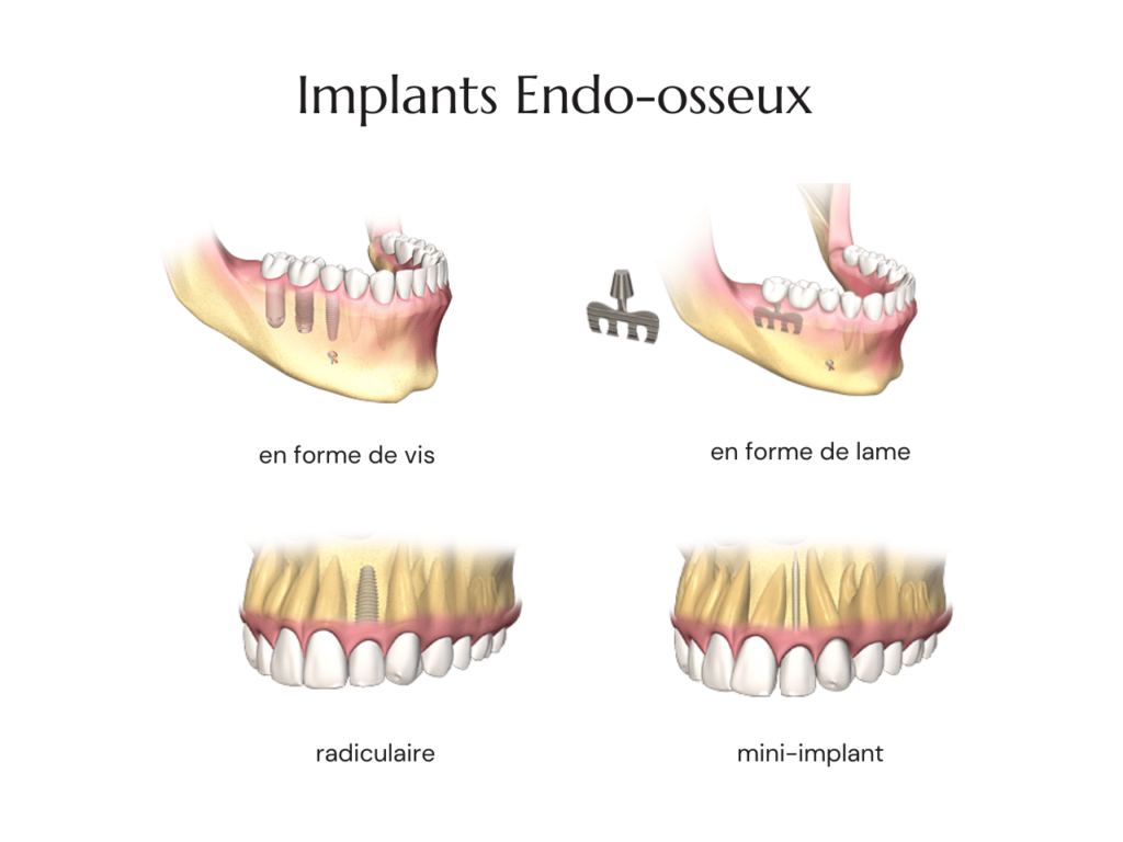 Implants Dentaires Endo Osseux