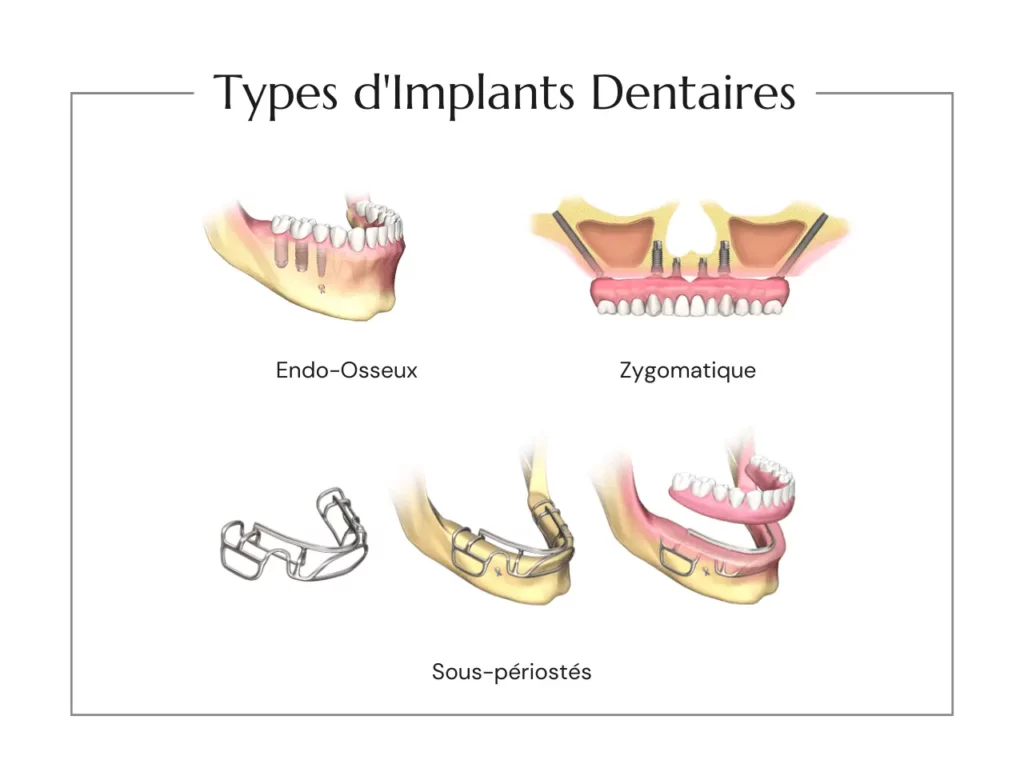 Types Implants Dentaires