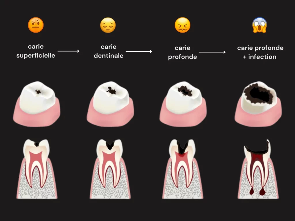 Evolution de la carie dentaire