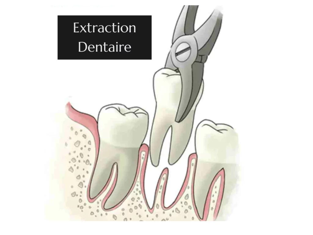 Extraction Dentaire