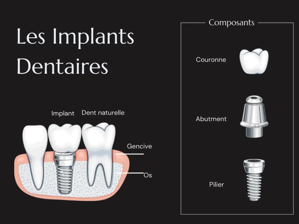 Qu'est-ce que les Implants Dentaires ?