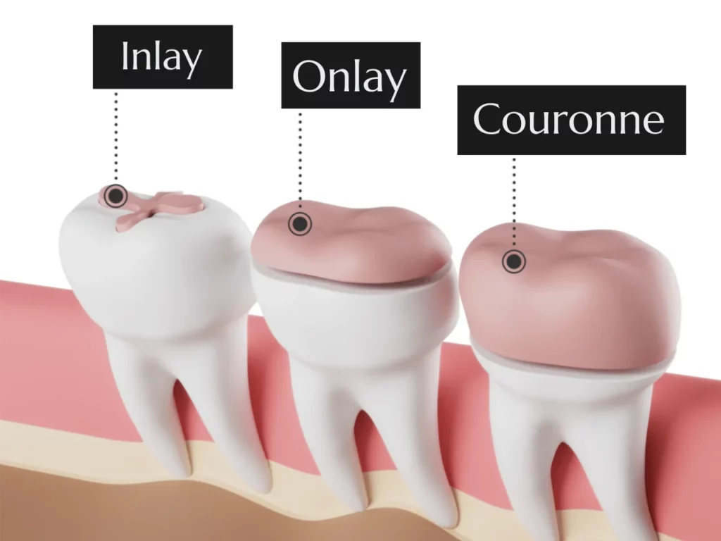 Inlay Onlay Couronne