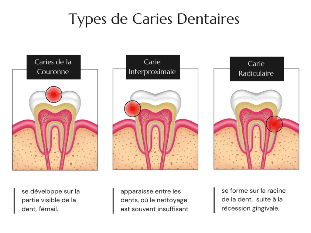 Les Types de Caries Dentaires