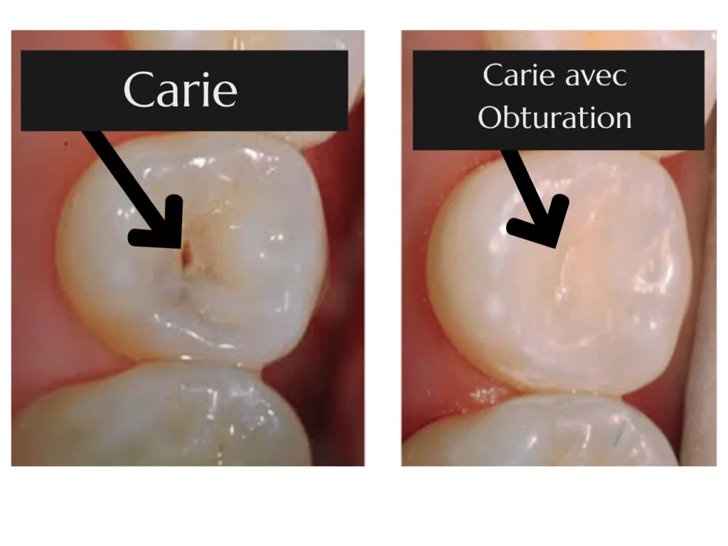 Obturation ou Plombage