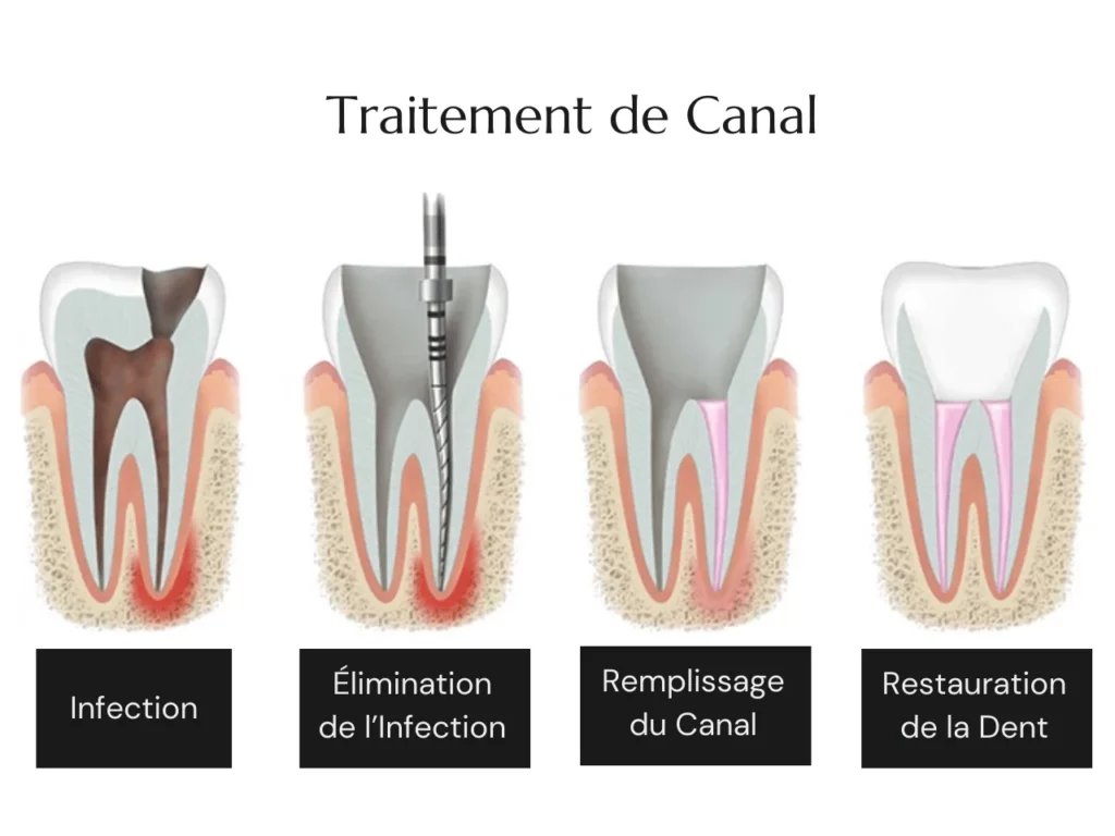 Traitment de Canal