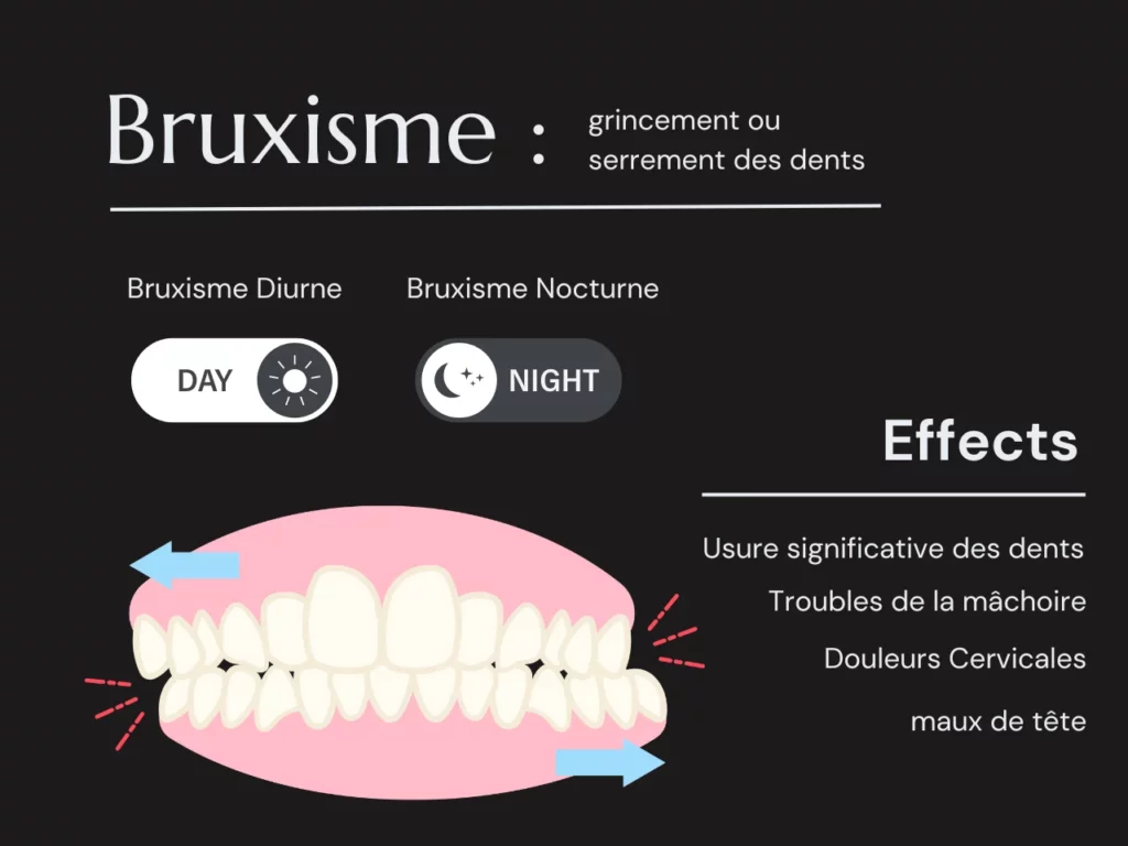 Definition du Bruxisme