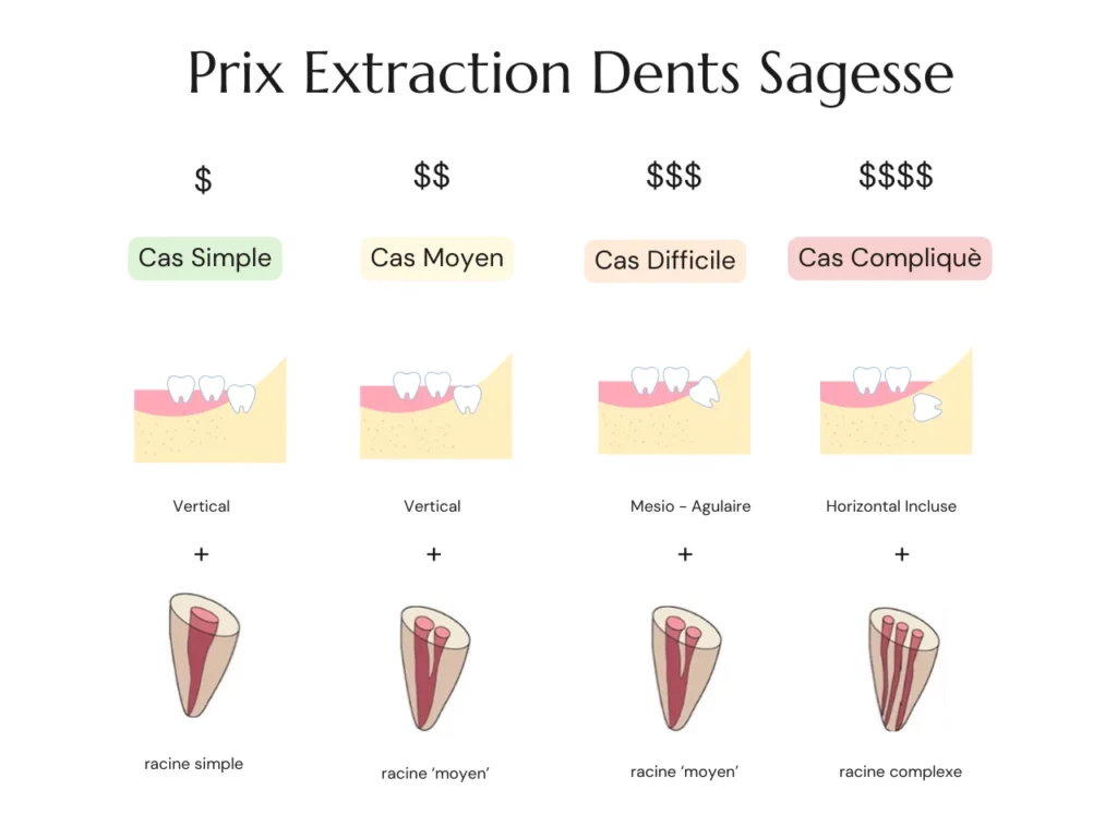 Prix Extraction Dents de Sagesse