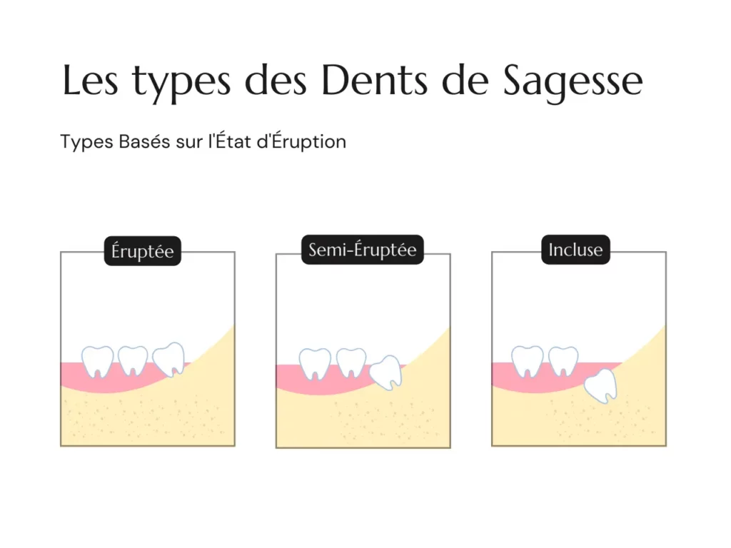 Types Dents de Sagesse Eruption