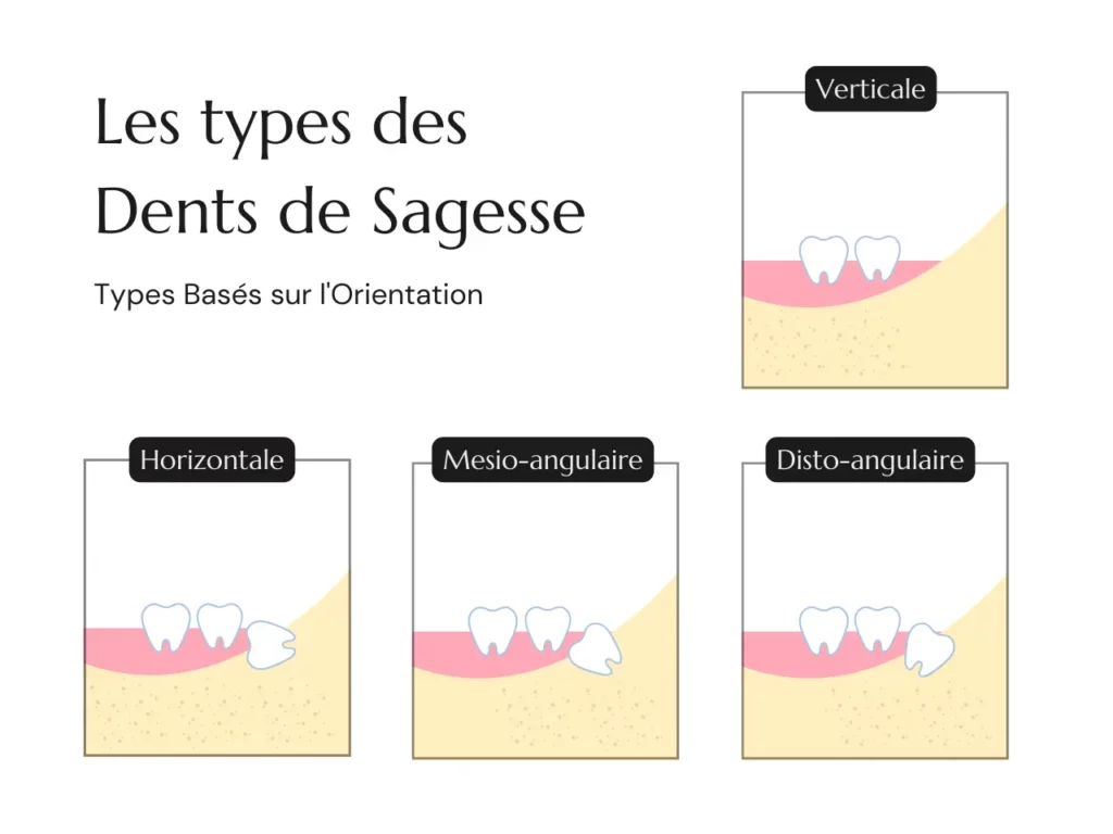 Types Dents de Sagesse Orientation