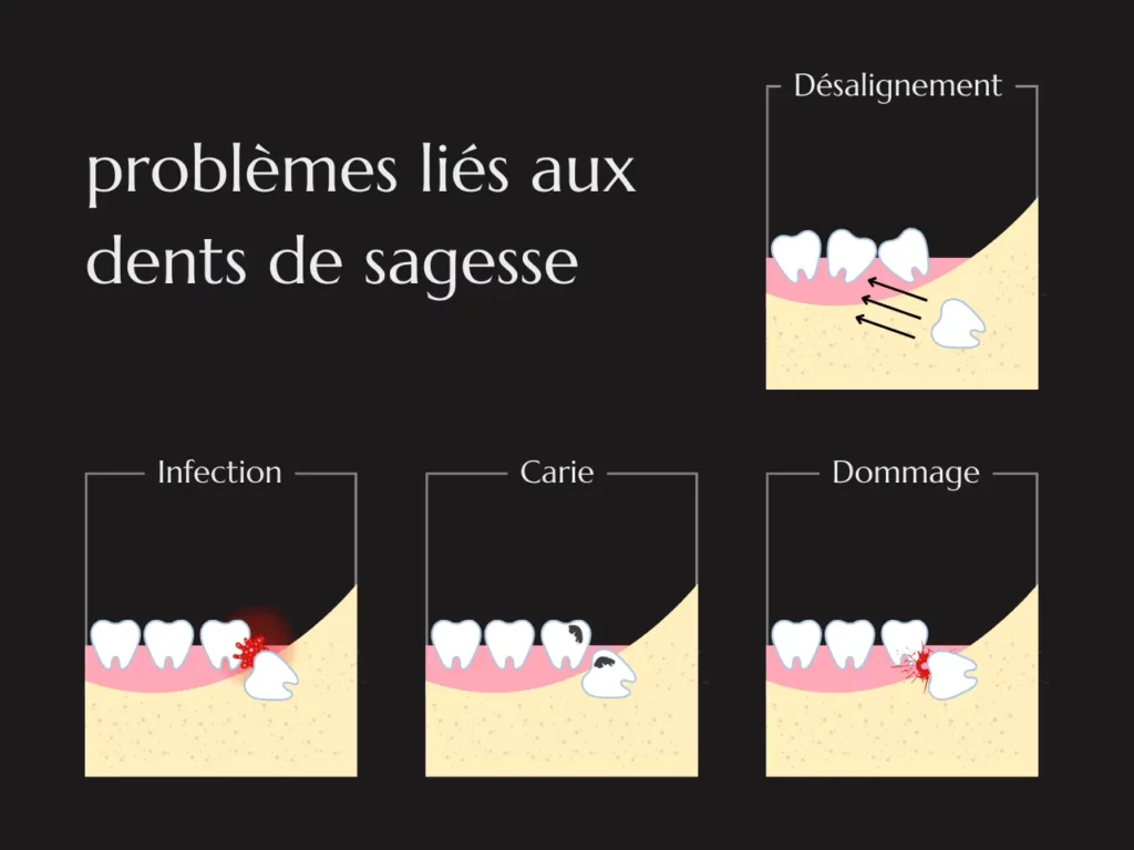 problèmes liés aux dents de sagesse